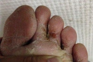 金鱼吊兰发霉烂了怎么办？（有效拯救你的金鱼吊兰，让它重新焕发生机！）